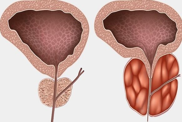 Inflamația prostatei