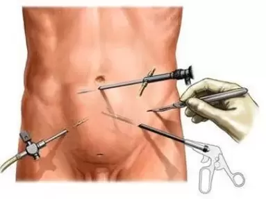 tratamentul chirurgical al prostatitei cronice