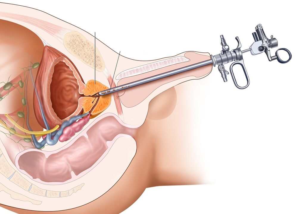 Rezecția transuretrală a prostatei vă permite să îndepărtați părțile afectate ale organului