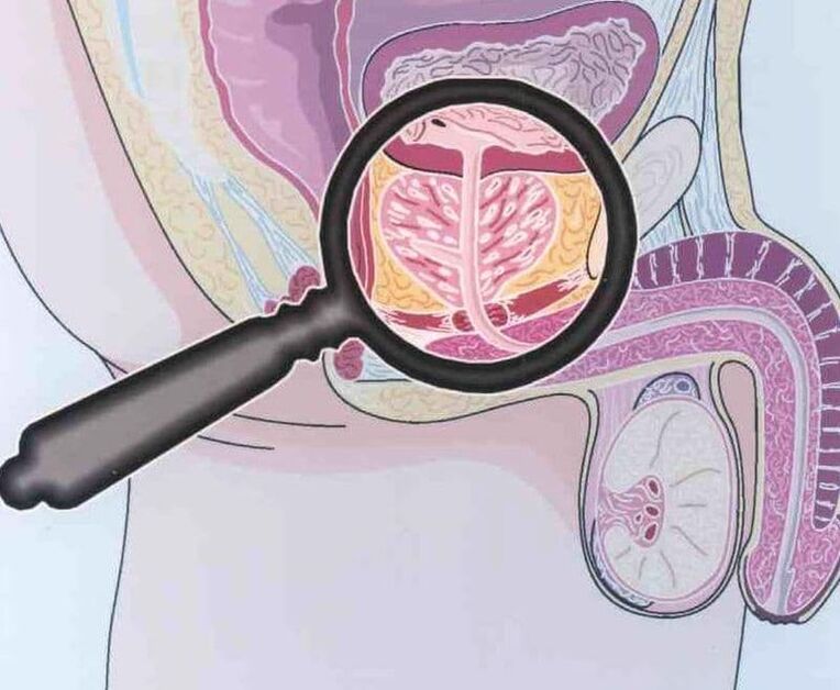 Implicarea țesutului prostatic la bărbații cu prostatită cronică